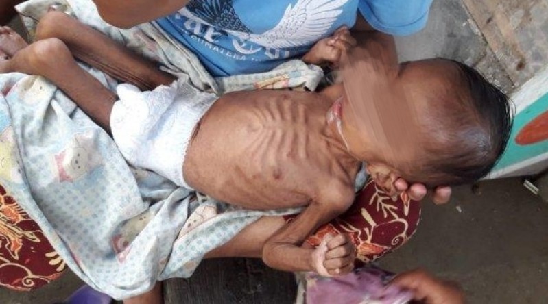 Cegah Stunting, Dinkes Aceh: Pentingnya Peran Orang Tua Terhadap Gizi Buruk Anak 2 Stunting